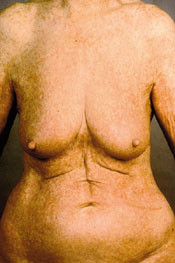 Figur 22  Mastocytos