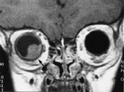 Figur 4  Koronalt T1-vektet bilde viser tumor i h&oslash;yre &oslash;ye med gjennomvekst av bulbusveggen (pil)