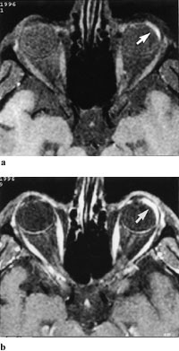Figur 5  a) 49 &aring;r gammel mann med venstresidig uvealt malignt melanom. Aksialt T1-vektet MR-bilde med fettsuppresjon f&oslash;r&hellip;