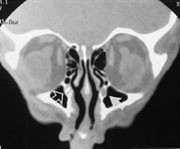 Figur 7  Koronalt CT-bilde etter drypping av Omnipaque kontrast i &oslash;ynene viser kontrastpassasje i t&aring;rekanalen p&aring; h&oslash;yre side &hellip;