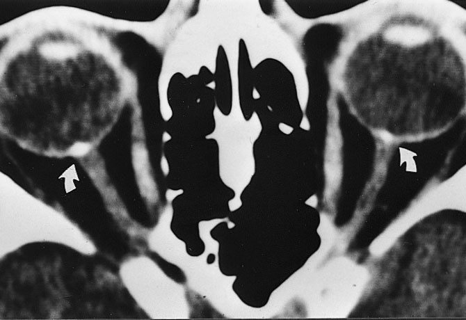 Figur 3  Aksialt CT-bilde viser hyaline avleiringer ved drusepapill bilateralt (piler)