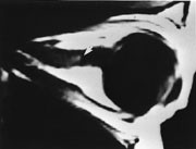 Figur 4  Synsnervebetennelse. Parasagittalt T1-vektet bilde med kontrast kan vise oppladning i nerven (flekket h&oslash;yt signal,&hellip;