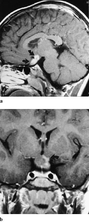 Figur 5  Fem &aring;r gammel gutt med ensidig optikusgliom.  a) Den fortykkede nerven kan ikke sees som en separat struktur, men&hellip;