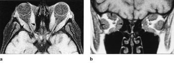 Figur 7  a) 48 gammel kvinne med exophthalmus og synsaffeksjon. Koronalt T1-vektet MR-bilde viser at synsnerven er&hellip;