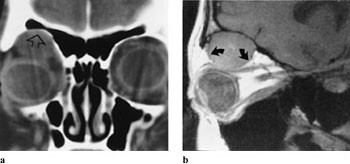 Figur 9  a) 17 &aring;r gammel pike med kapill&aelig;rt hemangiom. Koronal CT viser beinusur (pil). b) Sagittalt T1-vektet MR-bilde&hellip;