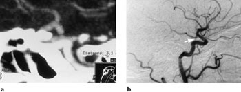 Figur 2  a) Rekonstruert CT-angiografibilde (sideplan) viser communicans posterior-aneurisme. Aneurismet for&aring;rsaket&hellip;