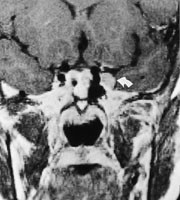 Figur 3  Koronalt T1-vektet MR-bilde med kontrast viser bukende tumor p&aring; venstre side oppad i sinus cavernosus. Dette&hellip;