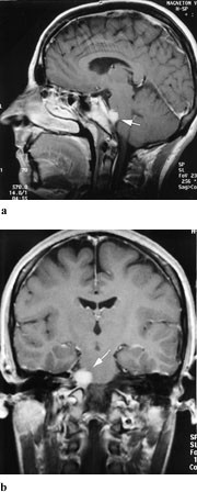 Figur 4  a) 32 &aring;r gammel kvinne med progredierende h&oslash;yresidig abducensparese. Sagittalt T1-vektet bilde med kontrast viser&hellip;