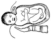 Figur 2  Ensidig skulderdystosi. Illustrasjon Ellinor M. Hoff