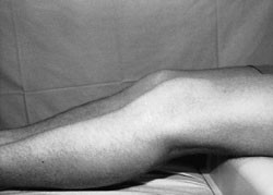 Figur 4  Gravity sign-test med bagudsynkning af tibia resulterende i &rdquo;h&aelig;ngek&oslash;jef&aelig;nomen&rdquo;