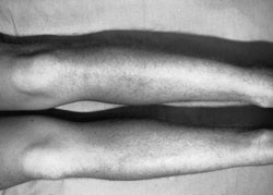 Figur 5  Eksternal rotation recurvatum-test