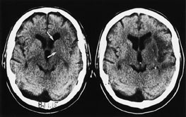 Figur 2  CT til venstre er tatt en time og 15 minutter etter symptomdebut. P&aring; affisert side er grensene for caput nucleus&hellip;