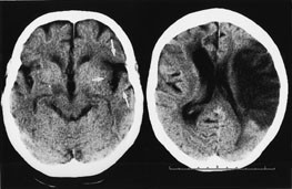 Figur 3  CT til venstre er tatt en time og 45 minutter etter symptomdebut. P&aring; affisert side viser de tre pilene at grensen&hellip;