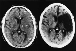 Figur 4  CT til venstre er tatt tre timer og ti minutter etter symptomdebut. Basalgangliene er ikke lenger tydelig&hellip;