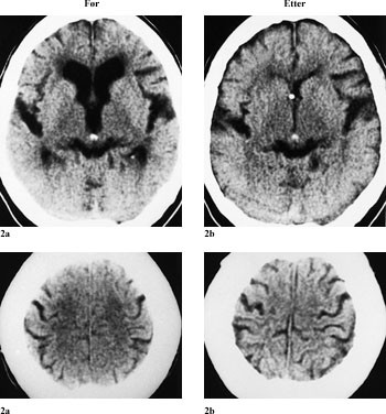 Figur 2   CT-bilder av pasient 4, a) f&oslash;r og b) tre m&aring;neder etter shuntinnleggelse. Hjerneventriklene (med hvit shuntspiss i&hellip;