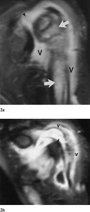 Figur 2   Koronale MR-SPIR-bilder a) ventralt og b) dorsalt etter intraven&oslash;s kontrast viser destruksjon proksimalt i&hellip;