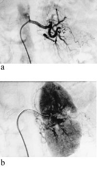 Figur 2   a) Trombe skj&oslash;vet perifert i arterie til venstre nyre (pil) etter rekanalisering og stenting av sentral h&oslash;ygradig&hellip;