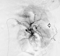 Figur 3   Kontrollangiografi av venstre nyre etter trombolyse. Tromben er tiln&aelig;rmet oppl&oslash;st, en kileformet&hellip;