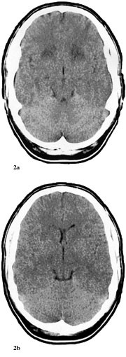 Figur 2   Cerebral CT av pasient 2, tatt 7.6. a) Viser flere hypodense omr&aring;der symmetrisk i basalgangliene og hele basale&hellip;