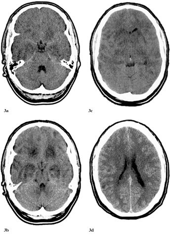 Figur 3   Cerebral CT av pasient 2, tatt 9.6. a og b) Viser at forandringene basalt progredierer og omfatter n&aring;&hellip;