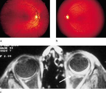 Figur 2   Pasient med vaskul&aelig;r malformasjon i venstre ansiktshalvdel. &Oslash;yebunnsfoto viser normale fargevariasjoner i sentrale&hellip;