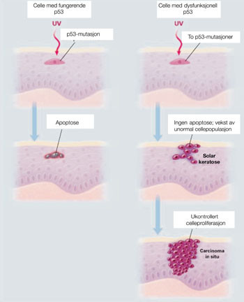 Figur 4   Modell for UV-indusert kutan karsinogenese: Ultrafiolett (UV) bestr&aring;ling induserer DNA-skader i keratinocyttene&hellip;