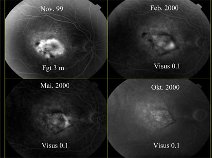 Figur 2  Fluoresceinangiografi av netthinnen hos en pasient. Bildet i november 1999 er tatt f&oslash;r behandling (Fgt =&hellip;