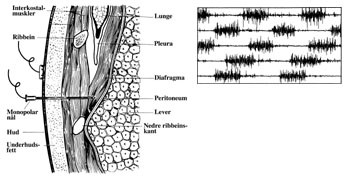 Figur 2   Skjematisk fremstilling av metoden ved EMG-registrering fra diafragma. N&aring;len settes inn 1 cm over diafragmas feste&hellip;
