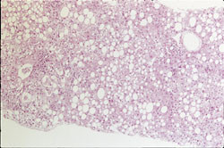 Figur 3   Histologisk snitt av leverbiopsi fra pasient 2. Ved rutinefarging (HE) ble det p&aring;vist storvakuol&aelig;r steatose i 70 &ndash;&hellip;