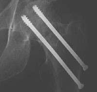 Figur 2   Osteosyntese av l&aring;rhalsbrudd med to AO cannulated screws