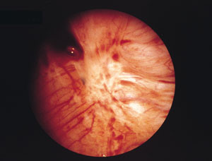 Figur 2   Endometriosh&auml;rd som delvis genomg&aring;tt fibr&ouml;s omvandling. (Illustration ur RW Shaw. Atlas of Endometriosis, 1993.)
