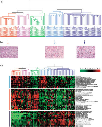 Figur 2   Klassifisering av brystkreftsvulster basert p&aring; genekspresjonsm&oslash;nstre. a) Hierarkisk klyngeanalyse som viser&hellip;