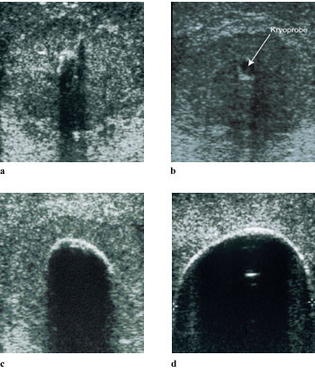 Figur 2   Kryoablasjon av levermetastase monitorert ved ultralyd. a) og b) viser en kryoprobe plassert sentralt i tumor i to&hellip;
