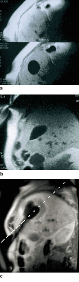 Figur 3   Kryoablasjon av levermetastase monitorert ved MR. a) og b) viser kryolesjonen i aksial- og sagittalplanet. Det&hellip;