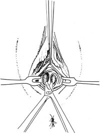Figur 2   Stump og skarp disseksjon i spatiet mellom urethra og anus