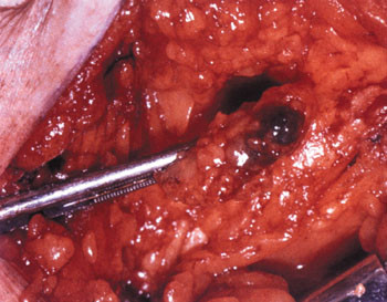 Figur 3   Vaktpostlymfekjertler i venstre lyske identifisert med bl&aring;fargeteknikk