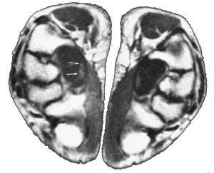 Figur 2   Bilateral MR av h&aring;ndleddet som viser to forgreninger av medianusnerven (piler)