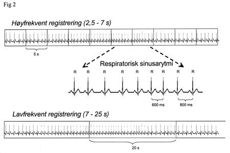 Figur 2   Registrering av RR-intervaller delt inn i kortere perioder. Hjertefrekvensvariabilitet frekvens-domene-analyse er&hellip;