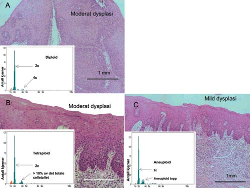 Figur 2   DNA-ploiditetsdistribusjonshistogrammer (innfelt) og histologiske funn hos to pasienter med moderat dysplasi (A og&hellip;
