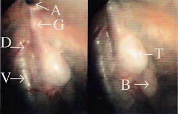 Figur 3   Laparoskopisk bilde av h&oslash;yre side. A er &aring;penst&aring;ende processus vaginalis, G er gubernaculum testis, D er ductus&hellip;