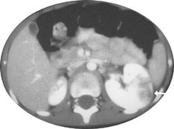 Figur 2   19 m&aring;neder gammel gutt. CT abdomen viser fokale segmentale forandringer i en stor venstre nyre og en liten&hellip;