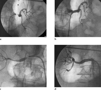 Figur 2   73 &aring;r gammel kvinne behandlet med angioplastikk og stent av stenoser sentralt i begge nyrearterier. a) og c) viser&hellip;