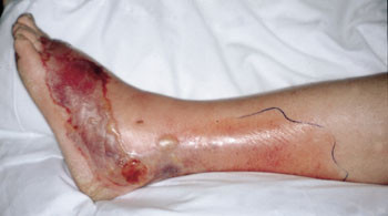 Figur 4   Nekrotiserende fasciitt hos 52 &aring;r gammel kvinne. Prim&aelig;rfokus var et lite s&aring;r p&aring; venstre lillet&aring;. Hun fikk feber,&hellip;