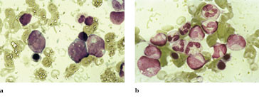 Figur 2   Pasientens beinmargsutstryk a) f&oslash;r og b) etter tre m&aring;neders kortisolbehandling. F&oslash;r behandling er margen noe&hellip;