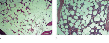 Figur 3   a) Beinmargsbiopsi f&oslash;r substitusjonsbehandling med kortisol. Beinmargen er hypocellul&aelig;r med en cellularitet p&aring; 15 &hellip;