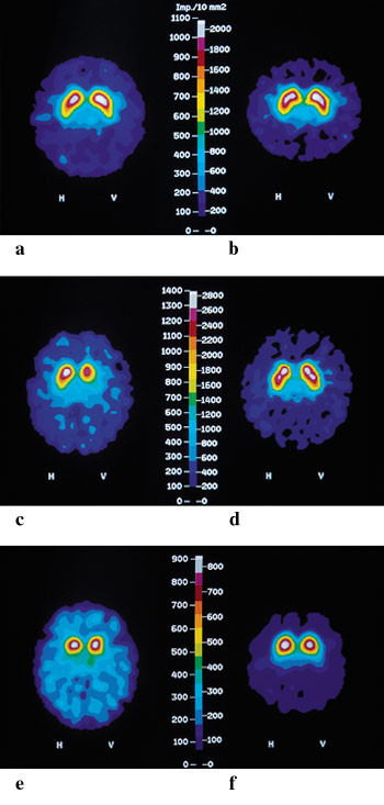 Figur 2   SPECT-unders&oslash;kelse med &beta; -CIT (a, c, e) og epideprid (b, d, f ) fra en frisk 41-&aring;rig mann (a-b), en 50 &aring;r gammel&hellip;