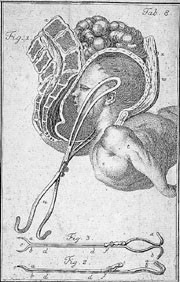 Figur 3   Levrets tang lagt p&aring; sistkommende hode ved setef&oslash;dsel. Fra Georg Wilhelm Steins Praktische Anleitung zur&hellip;