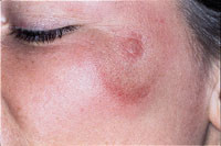 Figur 2   Stikkmerke (sjanker) p&aring; pasientens venstre kinn. Bildet er tatt 13 dager etter at hun ble stukket av tsetseflue