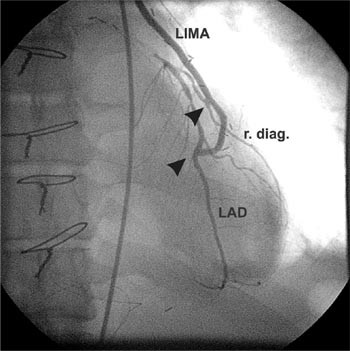 Figur 2   Sekvensanastomose: venstre a. mammaria (LIMA) er sydd side-til-side til ramus diagonalis (r. diag.) og deretter&hellip;