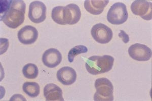 Figur 2   Tynn dr&aring;pe som viser bananformet gametocytt, som er diagnostisk for infeksjon med P falciparum